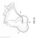 Fig. 10 - AMZ tibial tuberosity transfer system