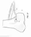 Fig. 11 - AMZ tibial tuberosity transfer system