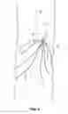 Fig. 05 - Embolus blood clot filter delivery system