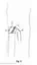 Fig. 06 - Embolus blood clot filter delivery system