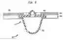 Fig. 07 - Device and method for compressing wounds