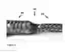 Fig. 05 - Surgical sutures incorporated with stem cells or other bioactive materials