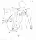 Fig. 02 - Pacing catheter with stent electrode