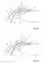 Fig. 05 - Ocular implant