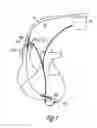 Fig. 02 - Temporary disablement feature for implantable device with anti-tachyarrhythmia functions