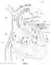 Fig. 02 - Ventricular assist device and related methods
