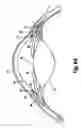 Fig. 06 - Shunt device and method for treating ocular disorders