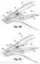 Fig. 07 - Shunt device and method for treating ocular disorders