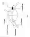 Fig. 02 - Implantable glaucoma drainage device