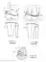 Fig. 02 - Orthopedic method for correcting angular bone deformity