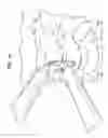 Fig. 35 - Instruments and methods for inserting artificial intervertebral implants