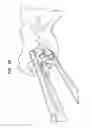 Fig. 49 - Instruments and methods for inserting artificial intervertebral implants