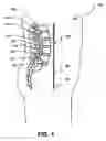 Fig. 02 - Implantable device and method of forming