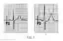 Fig. 02 - DETECTING PROLONGED MYOCARDIAL REPOLARIZATION INDICATIVE OF CARDIAC CONDITION