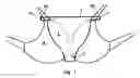 Fig. 02 - Cleavage accessory for a brassiere