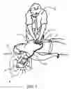 Fig. 02 - CPR assist device for measuring compression parameters during cardiopulmonary resuscitation