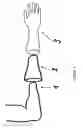 Fig. 02 - SYSTEM LINER AND MYOELECTRONIC ELECTRODE UNIT SYSTEM