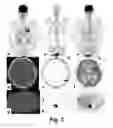 Fig. 03 - METHODS AND SYSTEMS FOR PET/CT SCANNING FOR EVALUATION OF MALIGNANCY