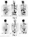 Fig. 04 - METHODS AND SYSTEMS FOR PET/CT SCANNING FOR EVALUATION OF MALIGNANCY