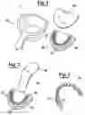 Fig. 02 - Method for producing a dental impression tray