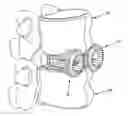 Fig. 01 - FUSION CAGE WITH REVERSE THREAD PROFILE (RTP)
