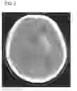 Fig. 03 - Method and apparatus for cerebral hemorrhage segmentation