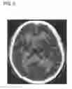 Fig. 06 - Method and apparatus for cerebral hemorrhage segmentation
