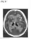 Fig. 09 - Method and apparatus for cerebral hemorrhage segmentation