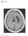 Fig. 12 - Method and apparatus for cerebral hemorrhage segmentation