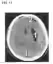 Fig. 14 - Method and apparatus for cerebral hemorrhage segmentation