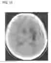 Fig. 16 - Method and apparatus for cerebral hemorrhage segmentation