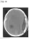 Fig. 17 - Method and apparatus for cerebral hemorrhage segmentation