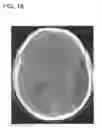 Fig. 19 - Method and apparatus for cerebral hemorrhage segmentation