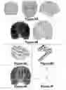 Fig. 05 - Three-dimensional localization, display, recording, and analysis of electrical activity in the cerebral cortex