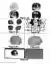 Fig. 09 - Three-dimensional localization, display, recording, and analysis of electrical activity in the cerebral cortex