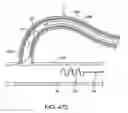 Fig. 45 - Needle assembly for tissue manipulation