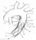 Fig. 01 - Total aortic arch reconstruction graft