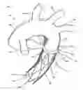 Fig. 02 - Total aortic arch reconstruction graft