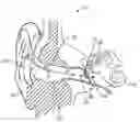 Fig. 01 - Optical electro-mechanical hearing devices with separate power and signal components