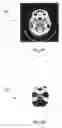 Fig. 09 - Brain image segmentation from ct data