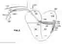 Fig. 07 - Devices and methods for accelerometer-based characterization of cardiac function and identification of LV target pacing zones