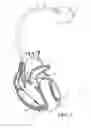 Fig. 02 - Implantable medical device with automatic sensing adjustment