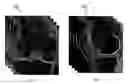 Fig. 01 - Fusion of multiple imaging planes for isotropic imaging in MRI and quantitative image analysis using isotropic or near-isotropic imaging