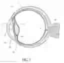 Fig. 02 - IMPLANTABLE OCULAR PUMP TO REDUCE INTRAOCULAR PRESSURE