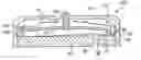 Fig. 01 - Drainage system for treating hydrocephalus