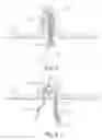 Fig. 04 - High Aspect Ratio Surgical Anchor and Method of Use