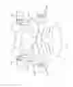 Fig. 03 - Multiple facet joint replacement