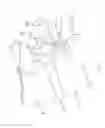 Fig. 04 - Multiple facet joint replacement
