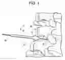 Fig. 02 - Conical interspinous apparatus and a method of performing interspinous distraction