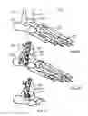 Fig. 03 - Tibia-talus-calcaneus (T-T-C) locking plate